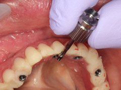 スクリュー固定式にて威力を発揮