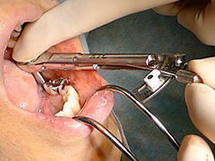 臼歯･隣在歯箇所に効果